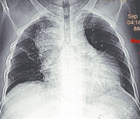 Chest X Ray Showing Radioopaque Extrapulmonary Mass Along The Right