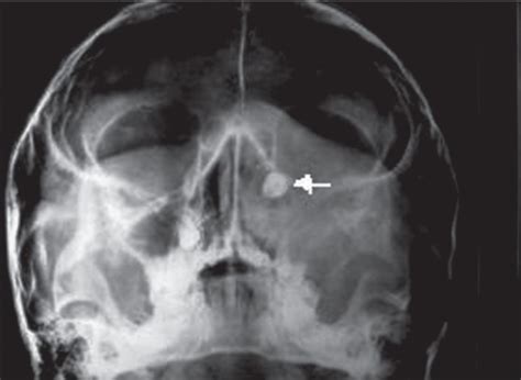 A Rare Cause Of Nasolacrimal Duct Obstruction Dentigerous Cyst In The