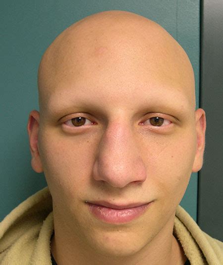 Alopecia universalis (au), also known as alopecia areata universalis, is a medical condition involving the loss of all body hair, including eyebrows, eyelashes, chest hair, armpit hair, and pubic hair. Alopecia universalis. Causes, symptoms, treatment Alopecia ...