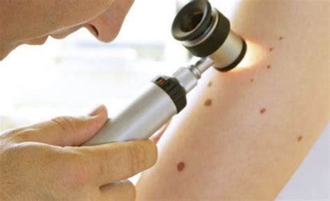 Count The Moles On Your Arm To Predict Skin Cancer Risk