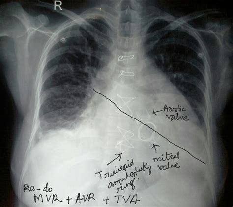 Aortic Valve Aortic Valve X Ray