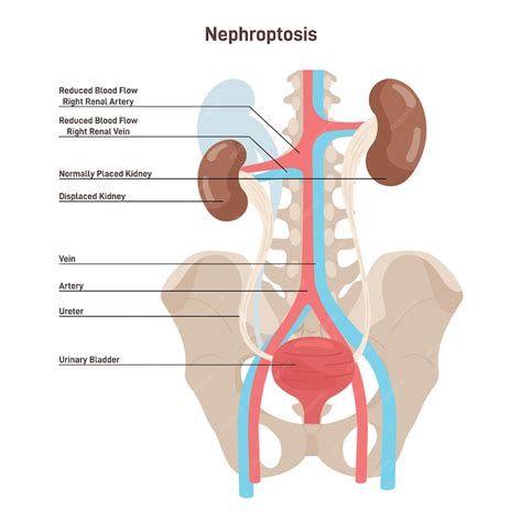 Premium Vector Nephroptosis Floating Kidney Or Renal Ptosis Condition