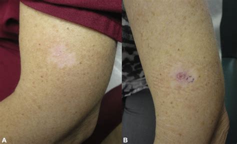 Two Reports Of Malignant Melanoma Arising Within A New Vitiligo Like