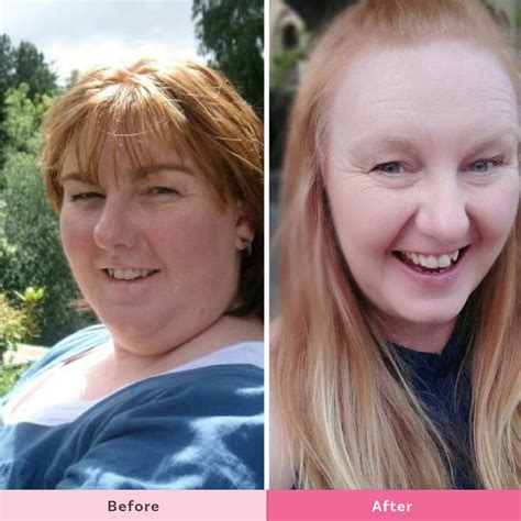 Melanie Shares How She Lost 29 Kgs And Her Colostomy Bag Both Gone For