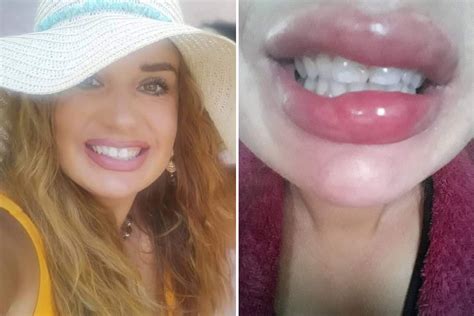Nhs Worker Branded A ‘monster After Botched Filler Made Her Lips