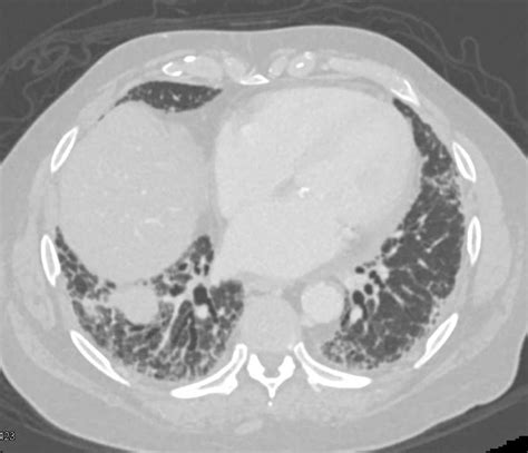 Ipf Lungs Chest Case Studies Ctisus Ct Scanning