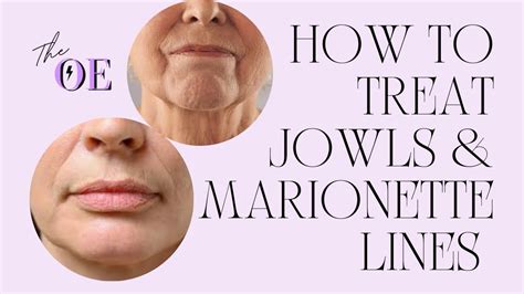 How To Treat Jowls And Marionette Lines At Home Youtube