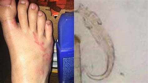 Teen Infected With Hookworms Could Feel The Worms Moving In His Body