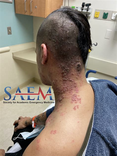 Saem Clinical Image Series A Rapidly Spreading Rash Laptrinhx News