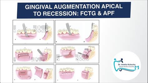 Free Connective Tissue Grafts And Apically Positioned Flap Gingival