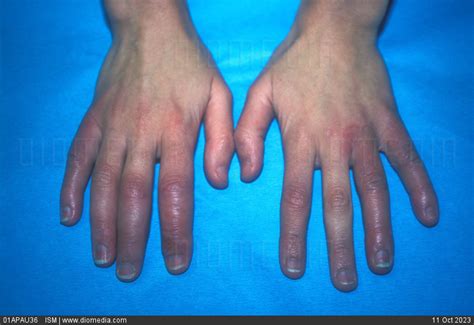 Stock Image Chilblain Lupus Of The Hands This Type Of Lupus