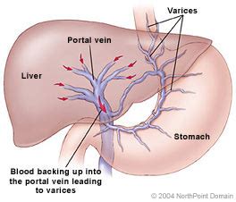 Blood in the arteries is a brighter red than blood in the veins because of the higher levels of oxygen found in the arteries. Portal Hypertension