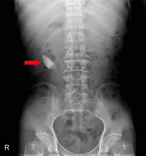 X Ray Or Ct Scan For Kidney Stone