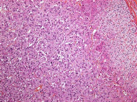 Pheochromocytoma Adrenal Gland Tumour Light Micrograph Stock Image