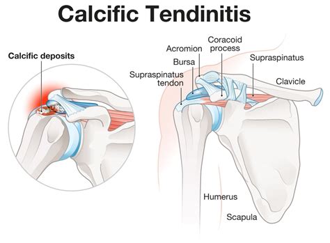 Calcific Tendinitis Of The Shoulder Complete Physio