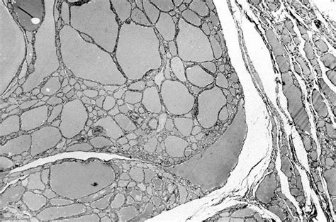 Pathology Outlines Thyroid Follicular Nodular Disease Multinodular