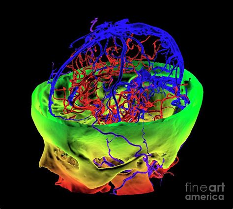 Brain Blood Vessels Photograph By K H Fungscience Photo Library