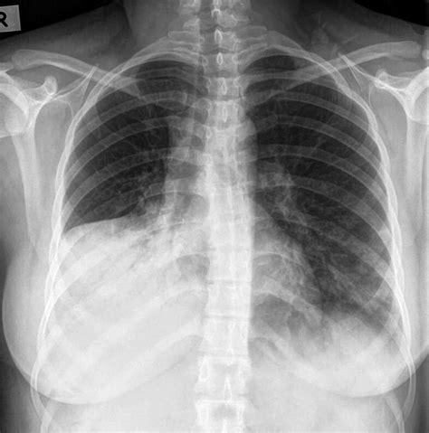 Ggo = ground glass opacity. Pulmonary Consolidation | Chest X-Ray - MedSchool