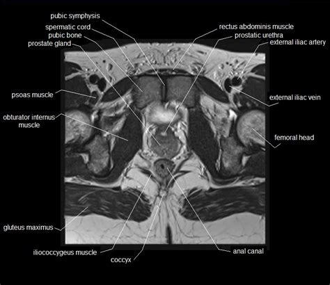 Ct Anatomy Pelvis Muscles Presentation1pptx Ct Normal Anatomy Of