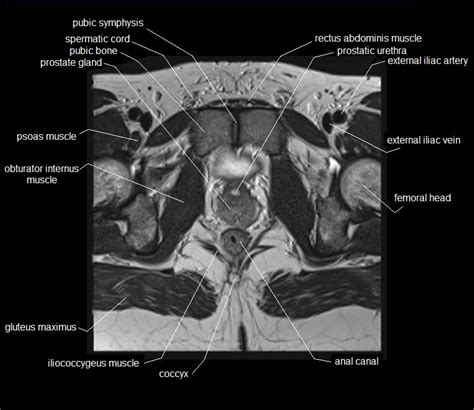 This webpage presents the anatomical structures found on knee mri. MRI pelvis anatomy | free male pelvis axial anatomy