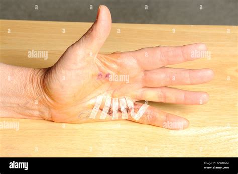 Dupuytrens Contracture After Surgery Stock Photo Alamy