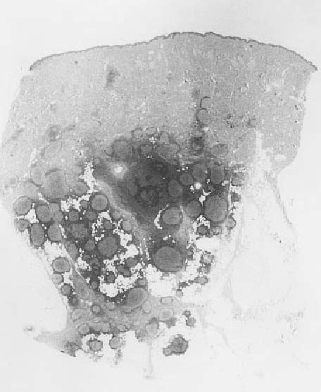 Figure 1 From Primary Cutaneous Follicle Center Cell Lymphoma With