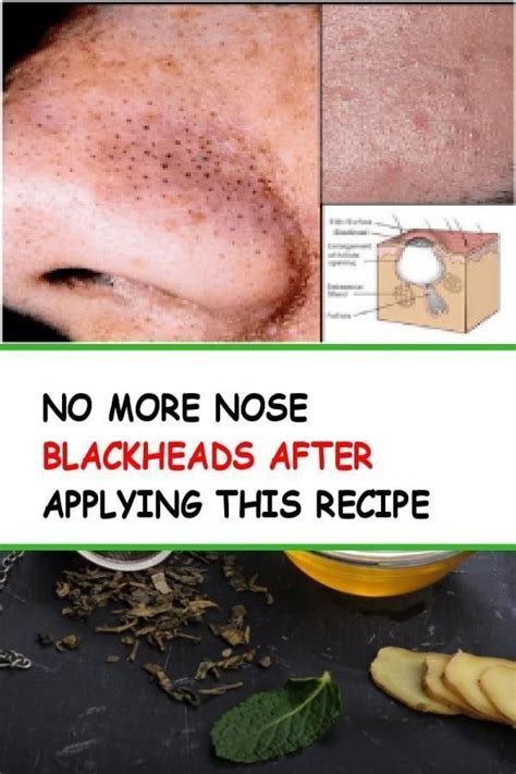 Pin By Kimberly Torres On Blackheads Blackheads Blackheads On Nose