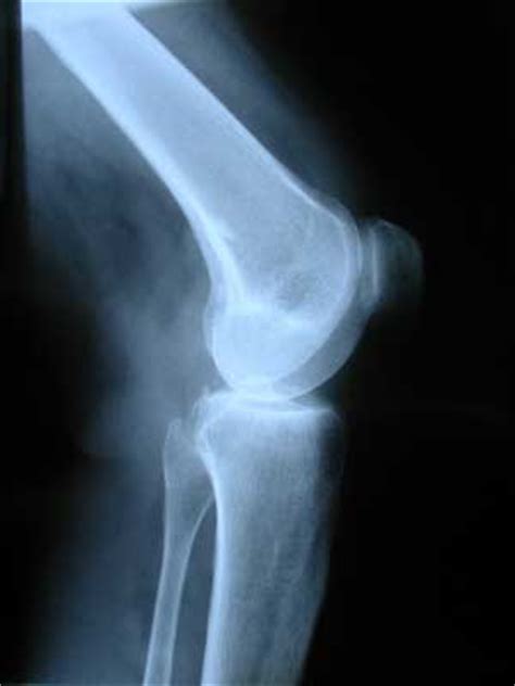 Bone cancers can originate from cells that normally reside in the bone space (primary cancer) or as a metastatic disease which has spread from cancers elsewhere in your pet's body. Life Expectancy Metastatic Bone Cancer