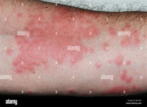 Close Up Of Rash On Arm From Portuguese Man O War Physalia Physalis