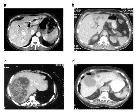 A D Ct Images Of Four Patients With Hepatic Abscesses Download