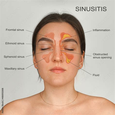 Sinusitis Healthy And Inflammation Nasal Sinus Medical Diagram Stock