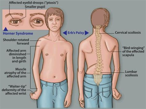 Erbs Palsy Pediatric Physical Therapy Brachial Plexus Physical