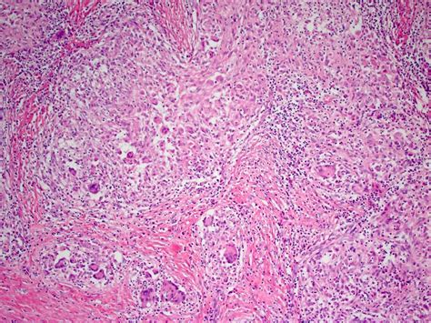 Pathology Outlines Tuberculosis