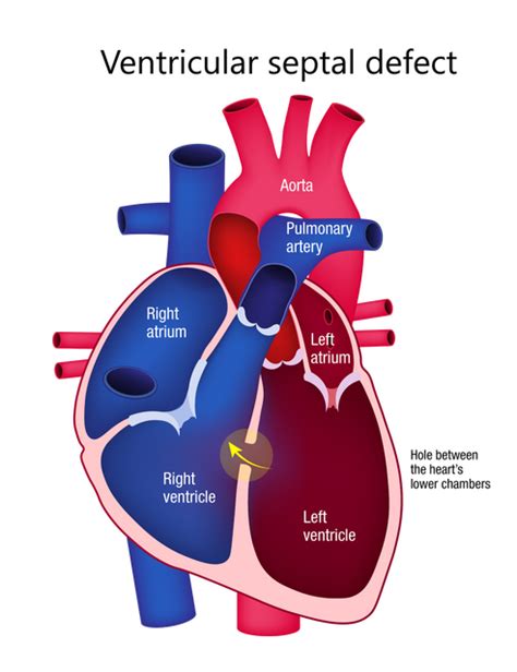 Congenital Heart Disease Heart Research Institute