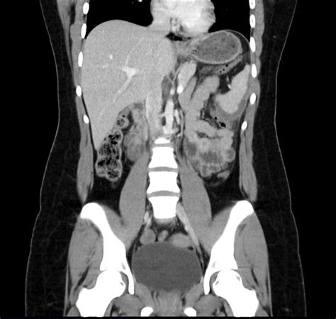 Subcapsular Splenic Haematoma In A Patient With Sickle Cell Trait Eurorad