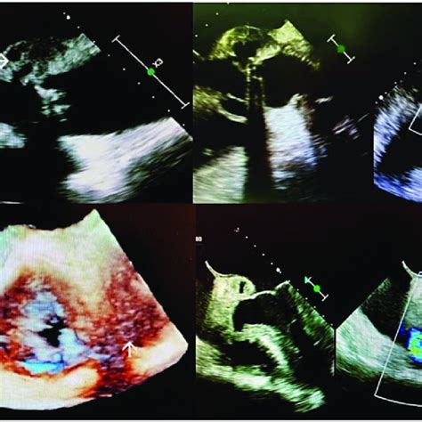 Transoesophageal Echocardiography Illustrating Aortic Root Abscess And