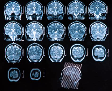 Brain Scan Study Discovers A New Type Of Schizophrenia
