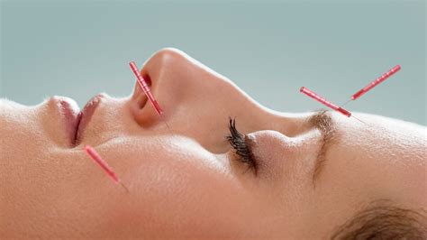 Cosmetic Acupuncture Altona Acupuncture
