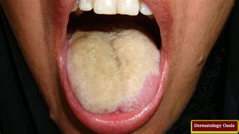 Coated Tongue Dermatology Oasis