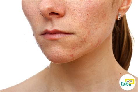 How To Get Rid Of Blemishes All You Need Infos