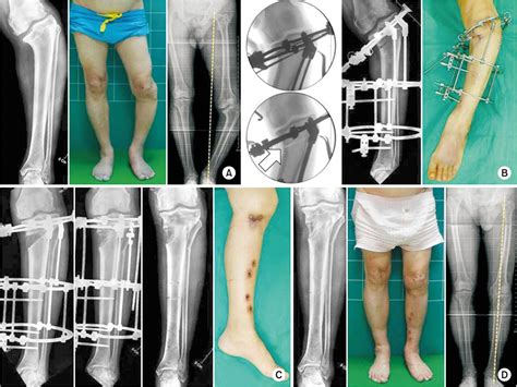 A Correction Of Malunion Or Deformity In The Lower Extremity