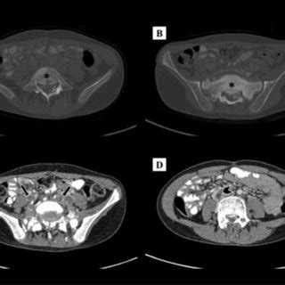 Axial Contrast Enhanced CT Of Thorax Abdomen And Pelvis Showing