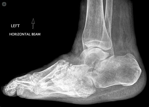 Charcot Foot What Is It Symptoms And Treatment Top Doctors