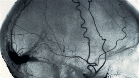 Brain And Spine Foundation Angiogram Of The Brain