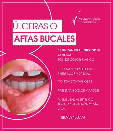 🩸las úlceras Bucales Dra Azucena Pardo Endodoncista Facebook
