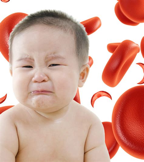 Infarctions in the spleen, kidneys, bone sickle cells lack elasticity and adhere to vascular endothelium, which disrupts microcirculation and causes vascular occlusion and subsequent. 6 Serious Symptoms Of Sickle Cell Anemia In Babies
