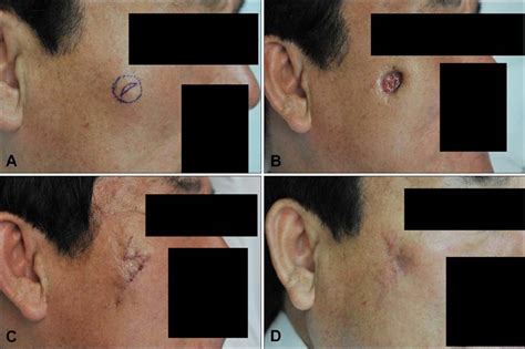 Treatment Of Nodular Fasciitis Occurring On The Face