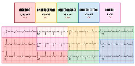 The 12 Lead Electrocardiogram Showing Extensive Septa