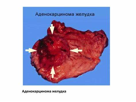Диета заболевания желудка