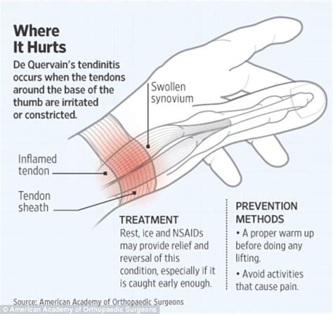 Top Images Tennis Wrist Pain Thumb Side My Elbow Pain Has Been Affecting My Tennis Game